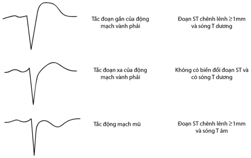 6. Phương pháp điều trị nhồi máu cơ tim thất phải